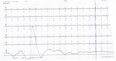Obr. 6  Vstupn EKG, hrudn svody