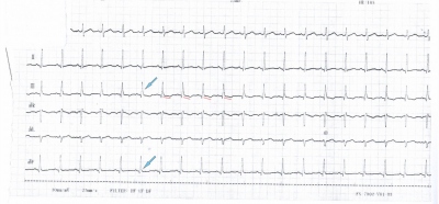 Obr. 5  Vstupn EKG, konetinov svody, modr ipky ukazuj notch ve svodu III a slurring ve svodu aVF, erven rky naznauj descendentn prbh seku ST ve svodu III.