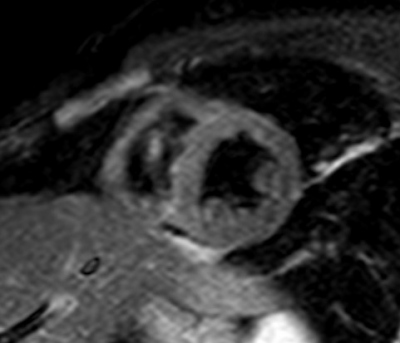 Obr. 14  Magnetick rezonance srdce, normln nlez, bez infiltrace myokardu