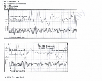 Obr. 1  Zznam z AED, prvn analza, defibrilovateln rytmus  fibrilace komor