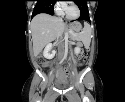 Obr. 1  Na abdominlnm CT je v koronrnm ezu zobrazena rozshl trombza vena cava inferior, proximln dosahujc a nad st renlnch il.