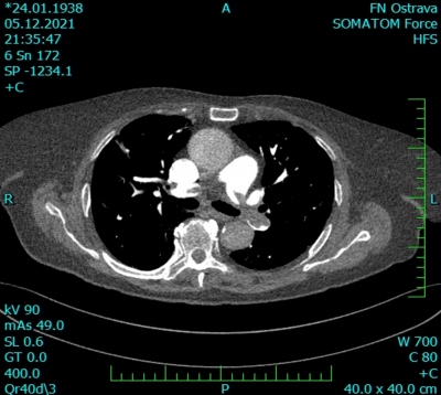 Obr. 3  CT angiografie plicnice, transverzln ez  emboly v plicnici bilaterln
