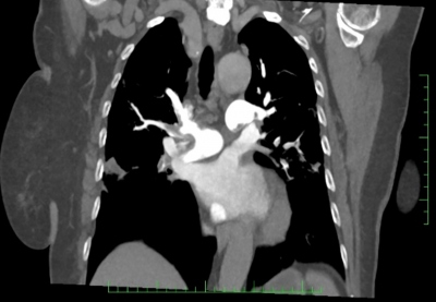 Obr. 2  CT angiografie plicnice, frontln ez  bilateraln plicn embolie