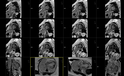 Obr. 2  Magnetick rezonance srdce s potvrzenm dilatace LK s tkou systolickou dysfunkc a s jizvenm subepikardiln (segmenty 1, 5, 6, 7, 12), typickm pro pozntliv stav