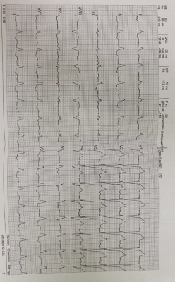 Obr. 1  EKG 42letho pacienta s DKMP  sinusov rytmus s  komplexu QRS 140 ms pi blokd levho Tawarova ramnka