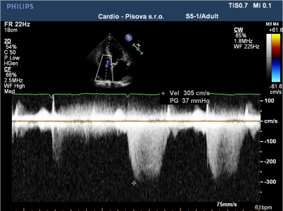 Obr. 4  Ukzky ultrazvukovch parametr pouvanch v diagnostickm algoritmu srdenho selhn se zachovanou ejekn frakc (HFpEF). (A) Men gradientu na trikuspidln chlopni
