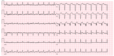 Obr. 1  Vstupn EKG s obrazem STEMI pedn stny. STEMI  infarkt myokardu s elevacemi seku ST.