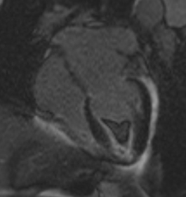 Obr. 2  Ve fzi pozdnho sycen gadoliniem je asignln tvar v hrotu lev komory (suspektn trombus). Je zde ptomen lem zvenho sycen mezi tmto tvarem a myokardem lev komory.