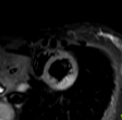 Obr. 4  Prkaz ischemickho loiska myokardu pi vyeten CMR. CMR  magnetick rezonance srdce.