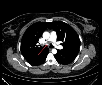 Fig. 1  CT angiography of the pulmonary artery with the thrombus entrapped in the pulmonary trunk.