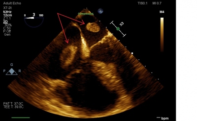 Fig. 4  Transesophageal echocardiography showing the thrombus floating in the left and right atria.