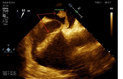 Fig. 5  Transesophageal echocardiography showing the serpentine thrombus entrapped in the patent foramen ovale and floating in the right and left ventricles.