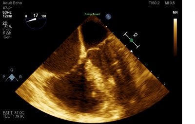 Fig. 6  Transesophageal echocardiography after removal of the thrombus from the right and left atria.