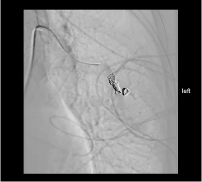 Obr. 4 � Uz�v�r pAVM v lev�m plicn�m poli.